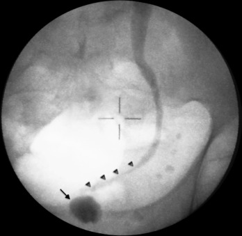 Pré‐operatório: bexiga de baixa capacidade (seta) e estenose do ureter terminal ...