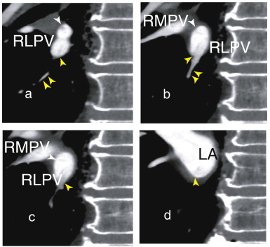a and Fig. 2b, a small dark inferior vessel (double yellow arrowhead) has a ...