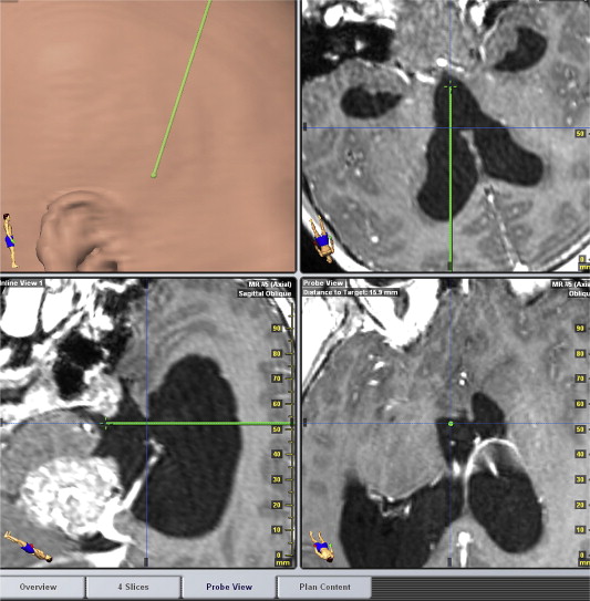 Measurement of the virtual displacement for endoscopic third ventriculostomy in ...