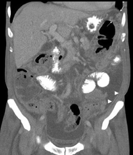 Contrast-enhanced computed tomography (CT) scan. Note the smooth thickening of ...
