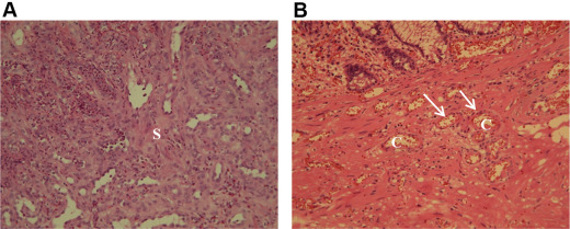 (A) Edematous collagenous stroma (s) with mixed inflammatory cell infiltration ...