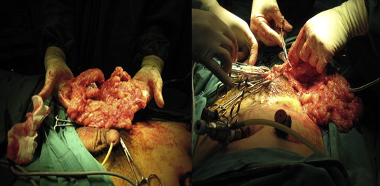 Excision of the omentum was performed when encountered upon opening of the ...