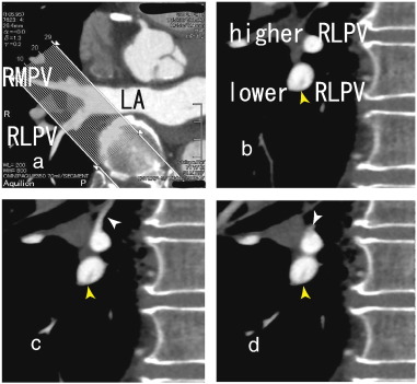 b, 64-MDCT images showed a thrombus in the lower right lower pulmonary vein ...