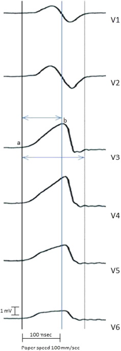 Calculation of the maximum deflection index.The maximum deflection index was ...