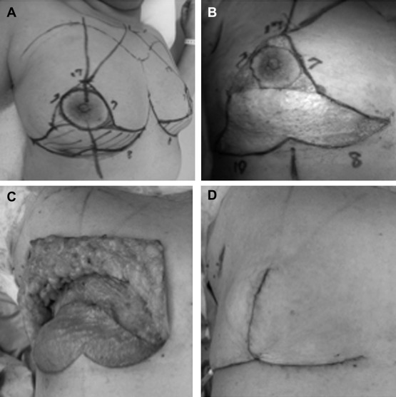 The surgical procedure: (A) preoperative drawing; (B) skin de-epithelialization; ...