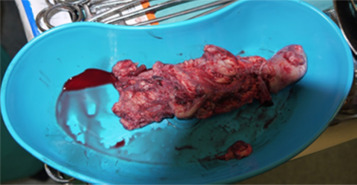 Peça de trombo após a cirurgia. Fragmento irregular branco com áreas ...