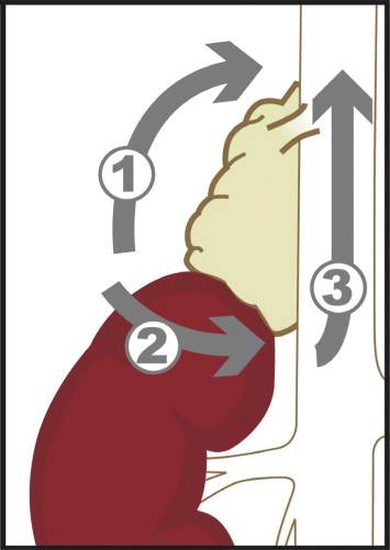Sequence of dissection for right adrenalectomy. Initial dissection started at ...