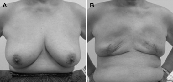 Case 1: (A) preoperative photograph; (B) photograph taken 7 months after the ...