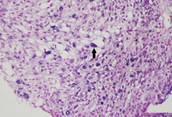 In situ hybridization of tumor cells revealed nuclear staining for Epstein–Barr ...