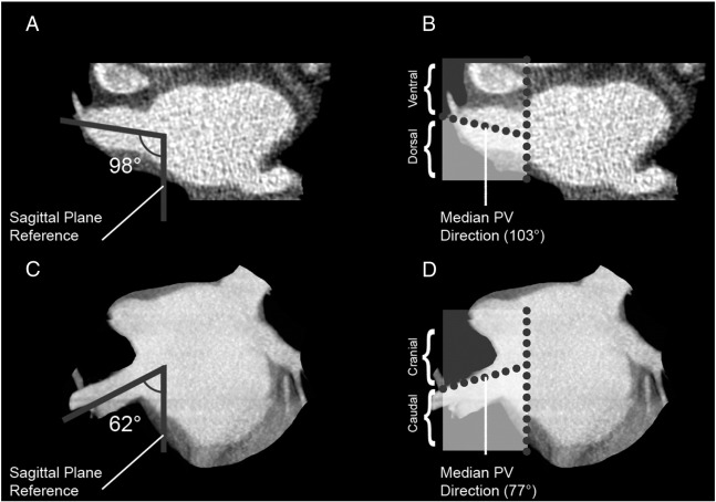 Example of right upper pulmonary vein orientation measurement in the transverse ...
