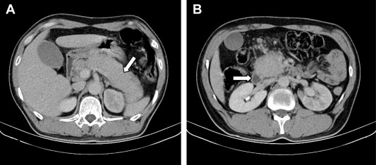 Enhanced computed tomography shows diffuse enlargement of the pancreas without ...