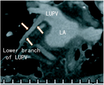 Coronal images showed an incomplete occlusion of the lower branch of the left ...