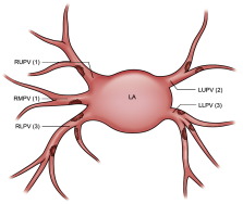 The frequency ratio of the pulmonary vein thrombi is shown. The frequency ratio ...