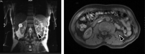 Estudo imagiológico com corte coronal em T2 (esquerda) e corte axial à esquerda ...