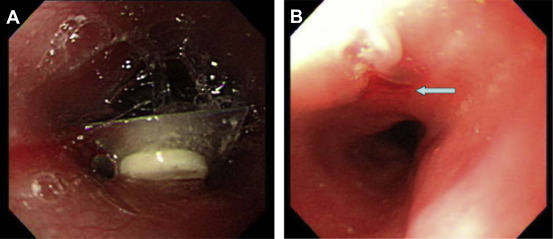 (A) A press-through-package 2cm in largest diameter with a sharp edge impacted ...