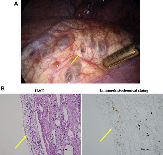 (A) Intraoperative findings of a perforation-like lesion in the tendinous part ...