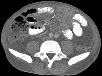Contrast-enhanced computed tomography (CT) scan. Note the crowded vascular ...