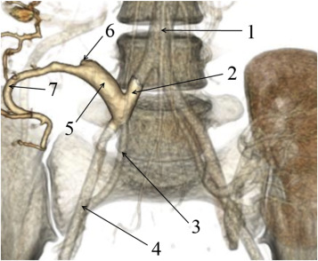 Abdominal computed tomography (Patient 34): (1) aorta; (2) common iliac artery; ...