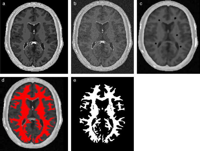 Materia blanca segmentada en volumen phantom. (a) Corte axial número 98 de ...