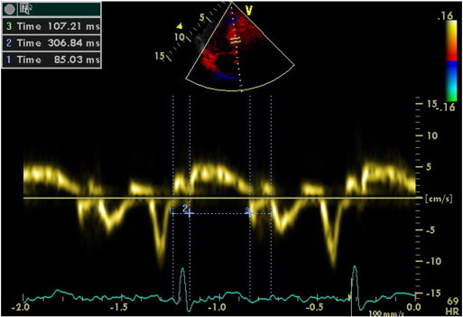 Evaluation of isovolumetric contraction time, contraction time and isovolumetric ...