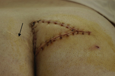 Fasciocutaneous V–Y advancement flap.