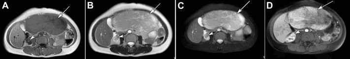 MR image of hepatic PEComa (arrows) complicated with renal PEComa (arrow heads) ...
