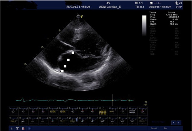 The dotted line indicates the actual position of the interatrial septum when one ...