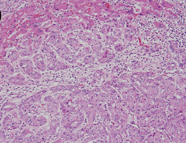 Pathological examination of the biopsy specimens of the tumor demonstrates ...