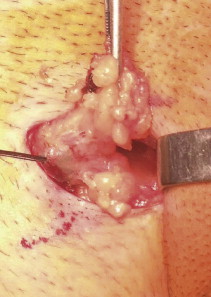 Plano de pormenor na exploração inguinal, da disseção do gânglio sentinela, que ...