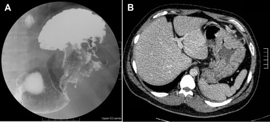 (A) Barium fluoroscopic upper gastrointestinal series and (B) upper abdominal ...