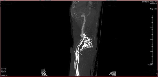 CT angiography image demonstrating absence of the infra- and suprarenal portions ...