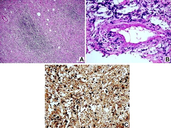 (A) Bland-appearing spindle cell proliferation in a fibrotic or sclerotic ...