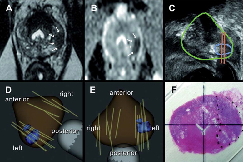 Ilustração da técnica - 59 year old man with a PSA of 7.4 and one prior negative ...