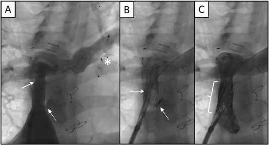 Fontan conduit angioplasty and fenestration closure. A: Fontan conduit stenosis ...