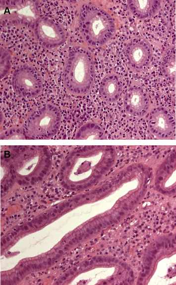 Histological examination of specimens taken from the ulcer margin show a similar ...