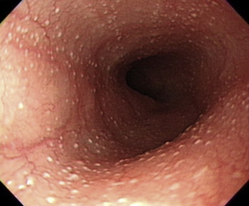 EGD revealed more than 100 tiny yellowish dots, 0.1 cm in diameter, scattered ...