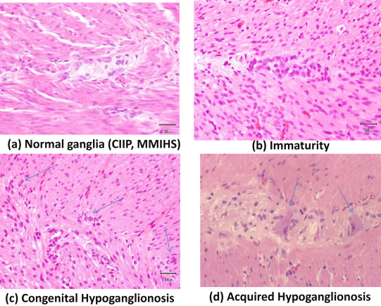 Typical pathology of allied disorders of Hirschsprungs disease (ADHD) in ...