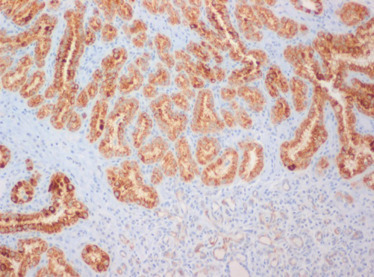 Estudo imunohistoquímico – expressão de P504s (alfa‐methylacyl coenzime‐A ...