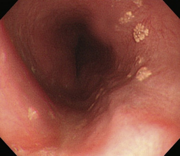 EGD revealed some well-defined, fern-like, yellowish lesions scattered over the ...