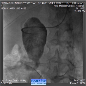 Selective injection into the aneurysm.