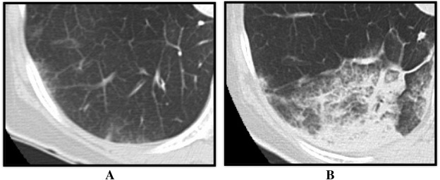 Representative case of computed tomography imaging of the reperfusion pulmonary ...