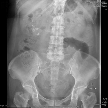 Small residual stone after single port nephrolithotomy.