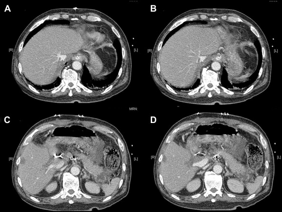 Computed tomography scan 1 week after the operation showed hypertrophy of the ...