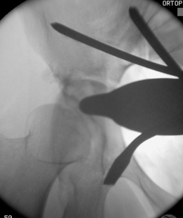Pubic rami osteotomy.