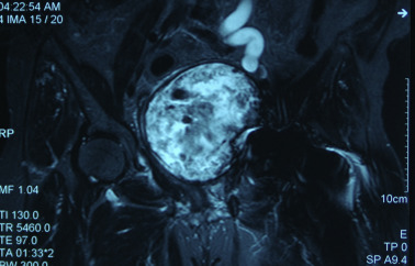 Coronal T2 weighted MRI. The mass is heterogeneous in nature, T2 hyperintense ...