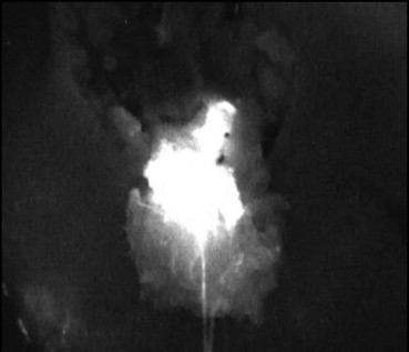 The fluorescence-enhanced mammary duct segment with collecting duct was removed ...