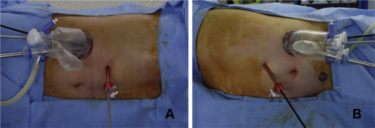 An extracorporeal view of dual incision laparoscopic adrenalectomy (A) right; ...