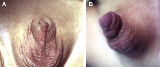 Appearance of the penis (A) before and (B) 1 month after the operation.