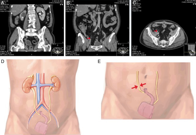 Nesta figura observamos em tomografia a presença de uretero‐hidronefrose direita ...