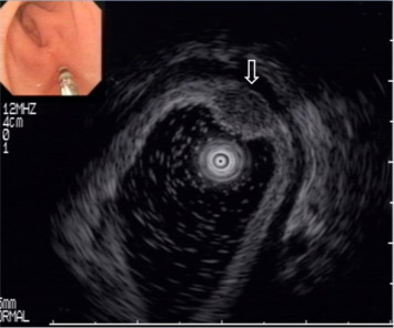 Endoscopic ultrasonography (Miniprobe 12 MHz, Olympus, Tokyo, Japan) shows an ...
